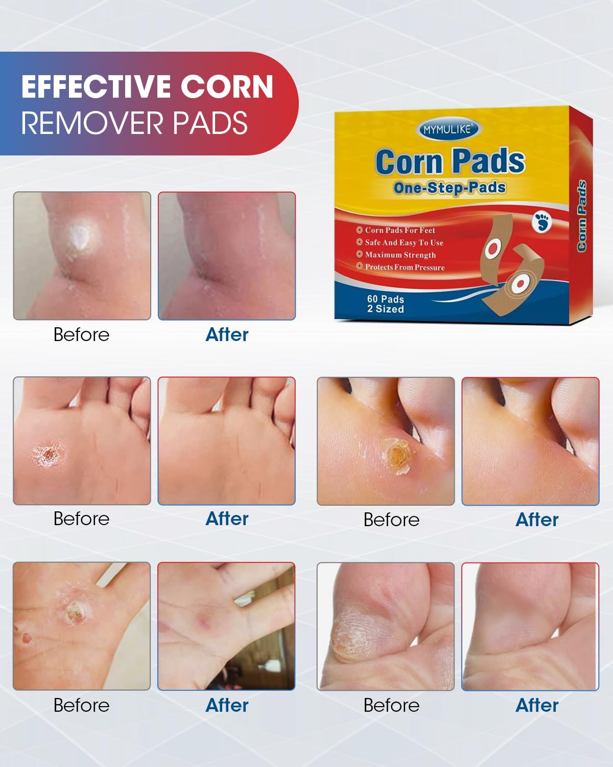 MYMULIKE Corn Removers for Feet 60 Pack, 30 Large Size and 30 Small Size Foot Corn Removers, 2 Size Corn Removers for Toe (60 Co