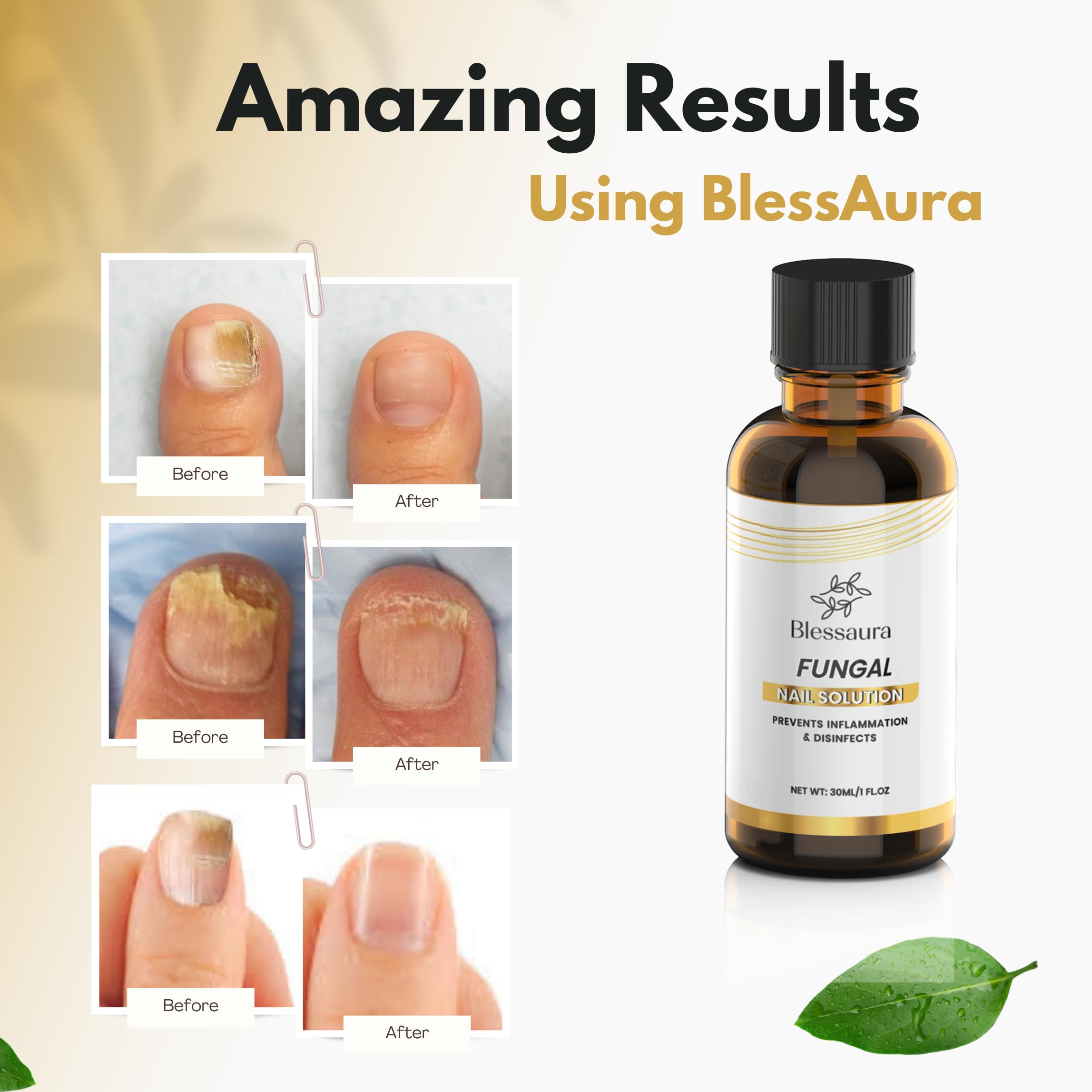 Toenail Fungus Treatment Extra Strength - Nail Repair Solution for Damaged, Thick, Discolored Nails - Natural Formula for Toenai