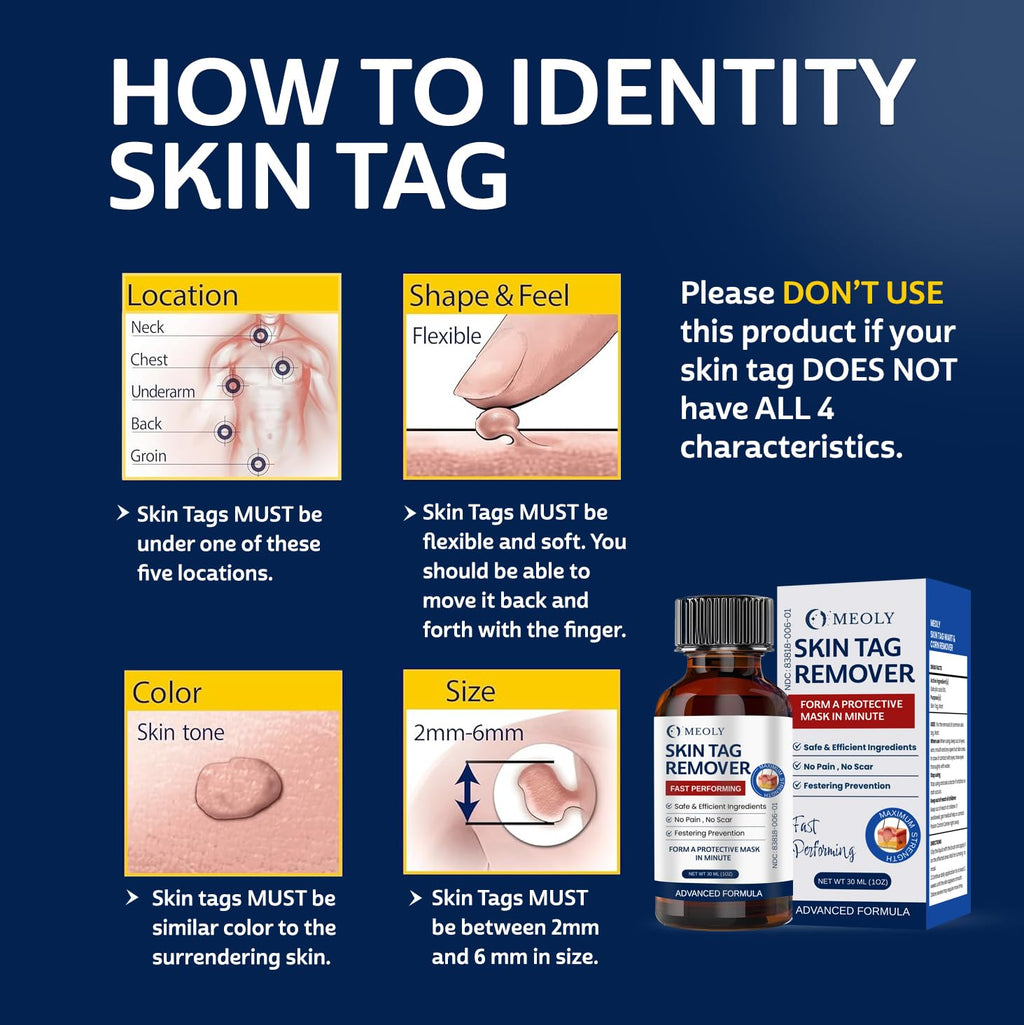 MEOLY Skin Tag Remover: Skin Tag Remover with Salicylic Acid for Men and Women 30 ML
