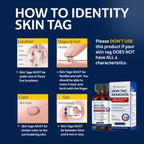 MEOLY Skin Tag Remover: Skin Tag Remover with Salicylic Acid for Men and Women 30 ML