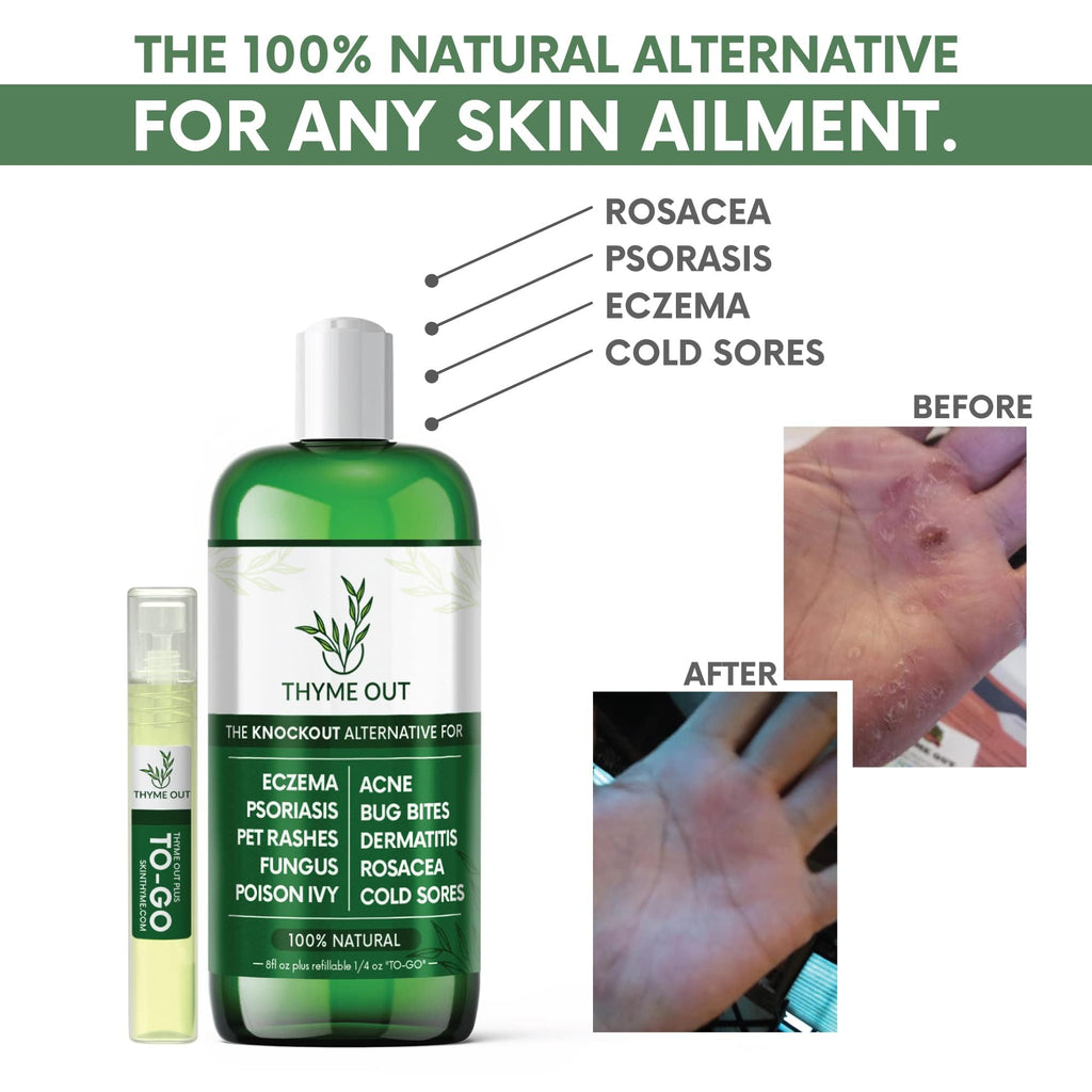 All Natural Eczema Treatment- Psoriasis Treatment - an All-in-One Solution for Acne, Dermatitis, Rosacea, Cold Sores, Pet Rashes