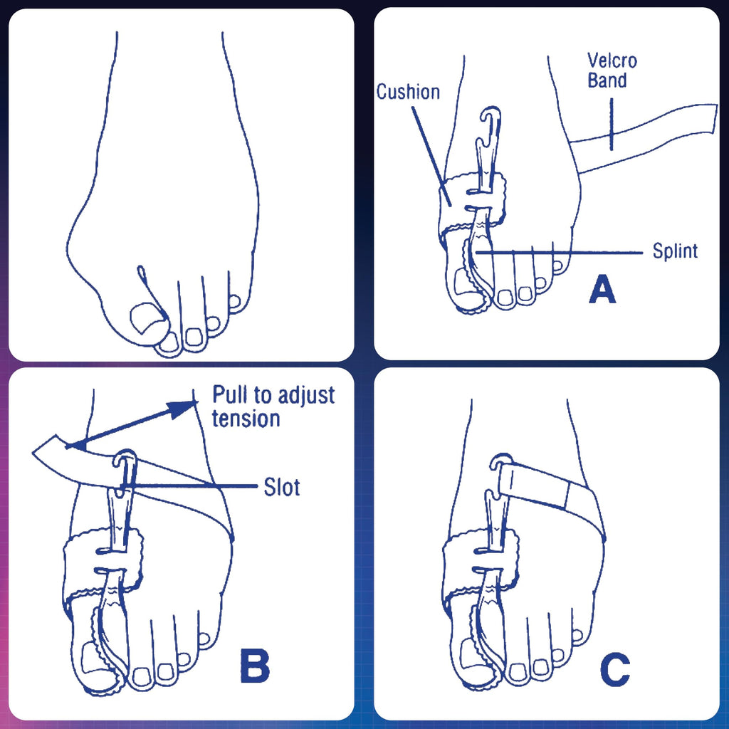 PediFix Nighttime Bunion Regulator, Large Left