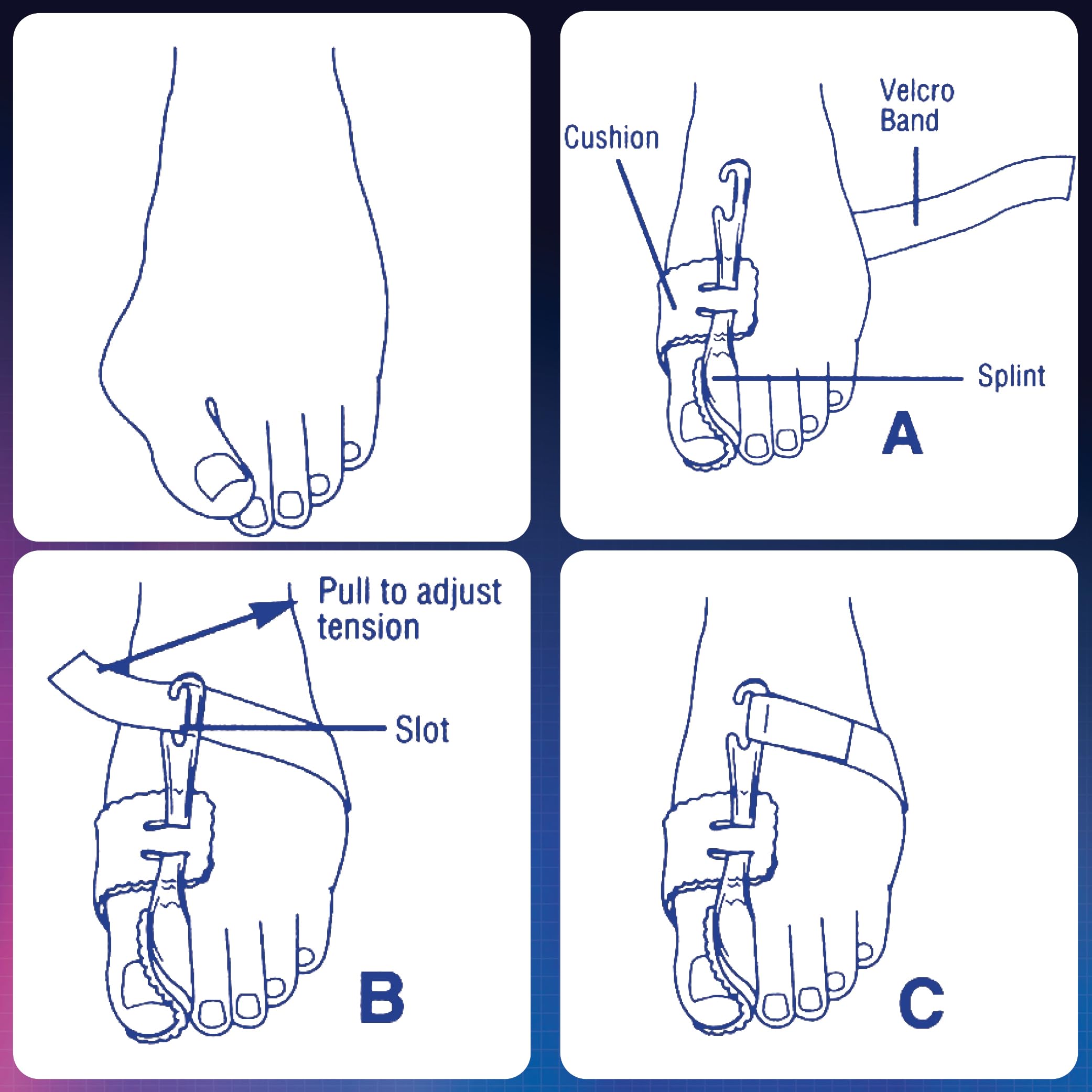 PediFix Nighttime Bunion Regulator, Right Foot, Medium