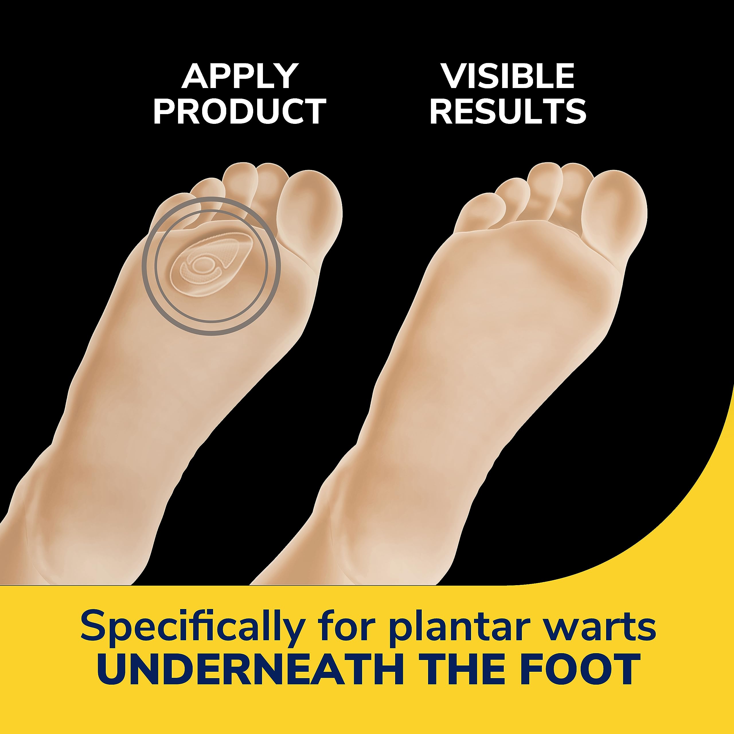 Dr. Scholl's Plantar WART Remover HYDROGEL Bandage 12 Discs 10 Cushions, Immediate Cushioning Pain Relief, Ultra-Thin, Maximum S