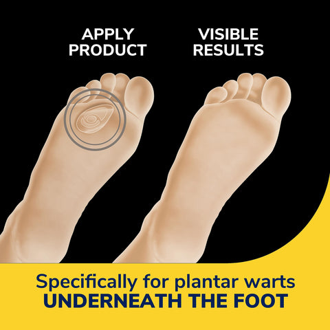 Dr. Scholl's Plantar WART Remover HYDROGEL Bandage 12 Discs 10 Cushions, Immediate Cushioning Pain Relief, Ultra-Thin, Maximum S