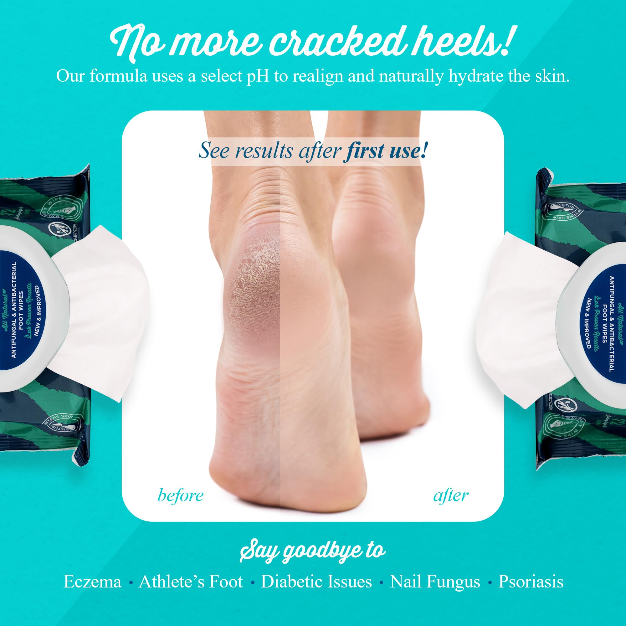 pHeet Foot Wipes All-Natural Antifungal & Antibacterial Formula, Cleanses, Moisturizes, Prevents & Kills Athletes Foot, Toenail