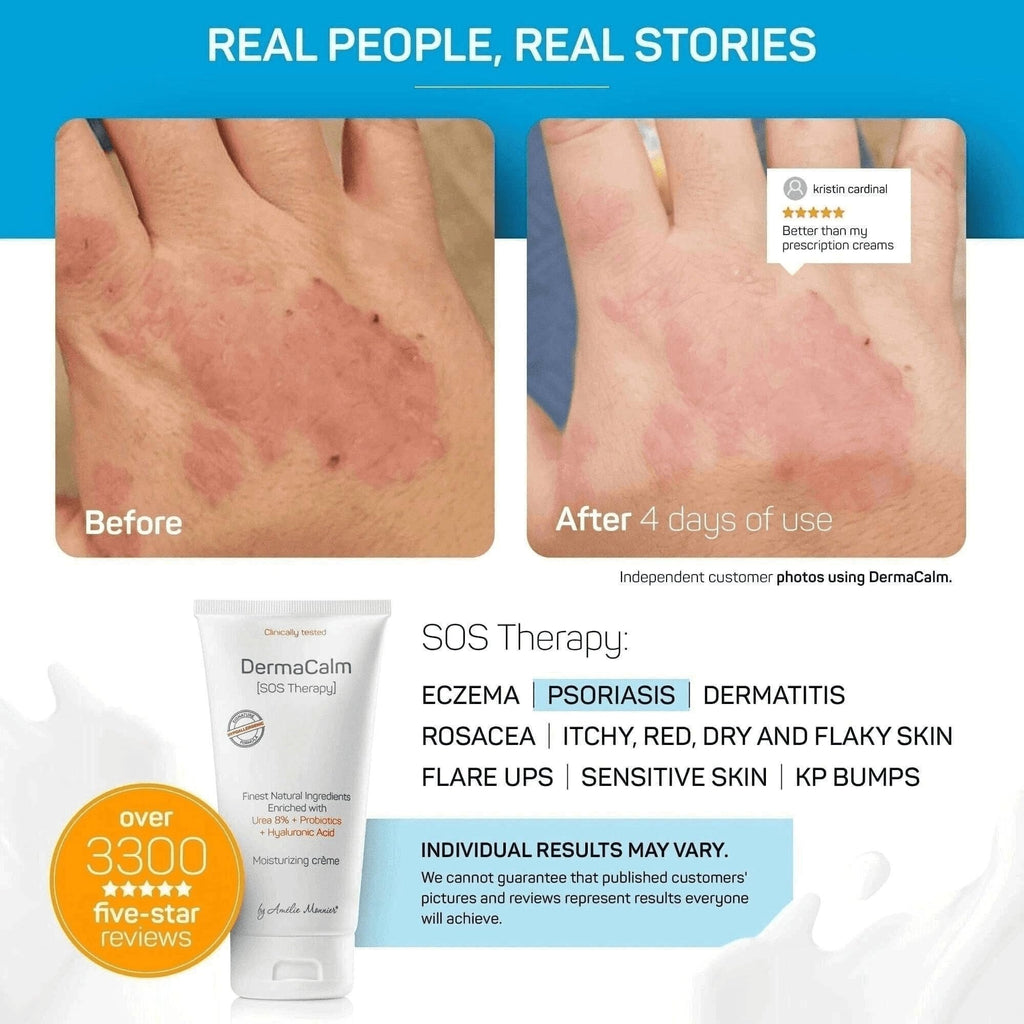 Clinically Tested DermaCalm SOS Therapy - Eczema Psoriasis Dermatitis Prone, Dry Skin - Urea 8%, Probiotics w/Best Natural Ingre