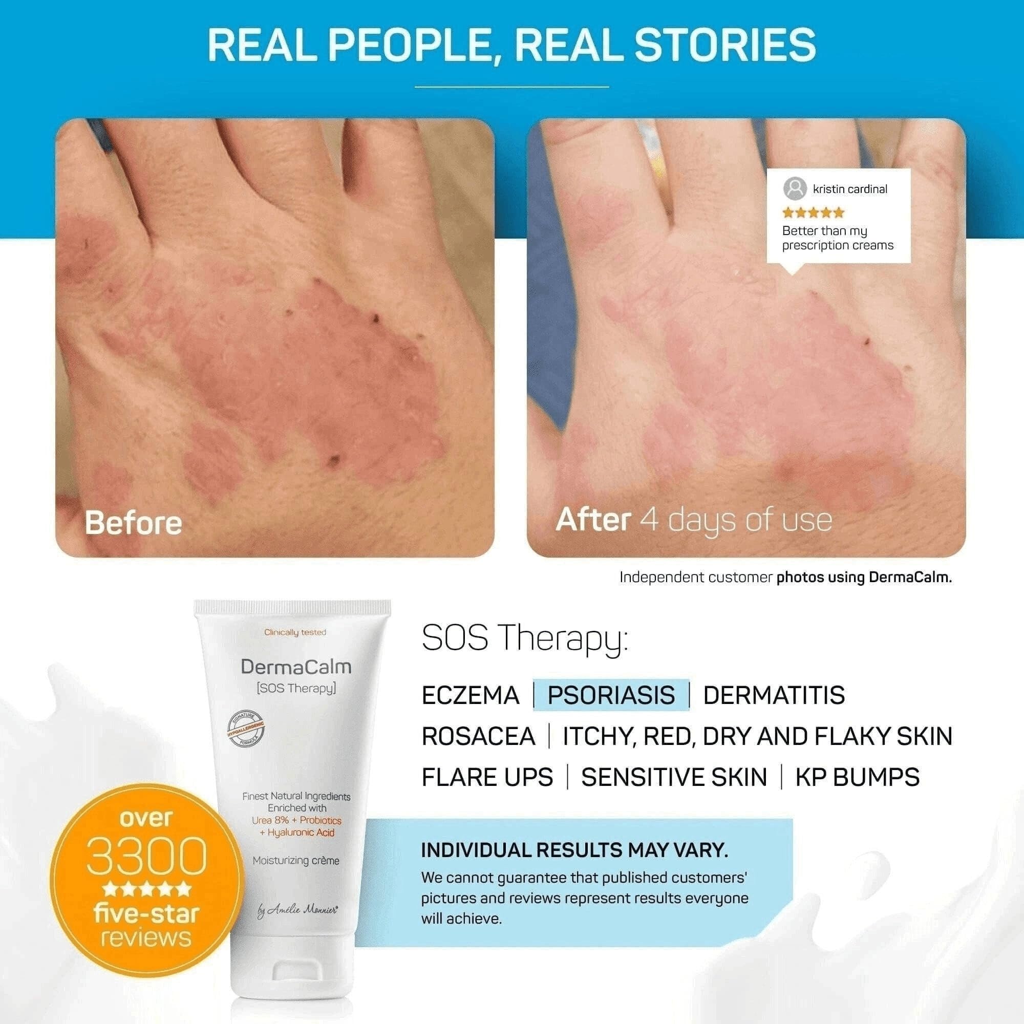Clinically Tested DermaCalm SOS Therapy - Eczema Psoriasis Dermatitis Prone, Dry Skin - Urea 8%, Probiotics w/Best Natural Ingre
