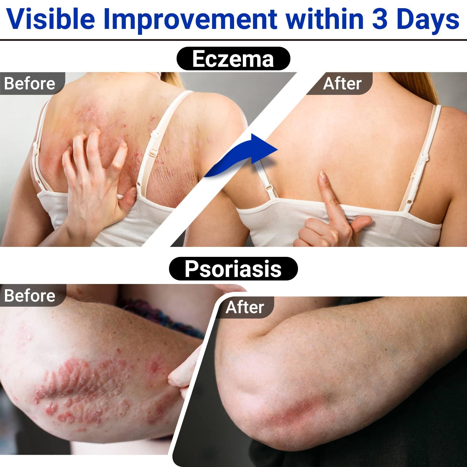 LMNOOP Eczema Cream, Maximum Strength Treatment Ointment for Rash, Psoriasis, Dermatitis, Urticaria, Jock Itch, Fungal Infection