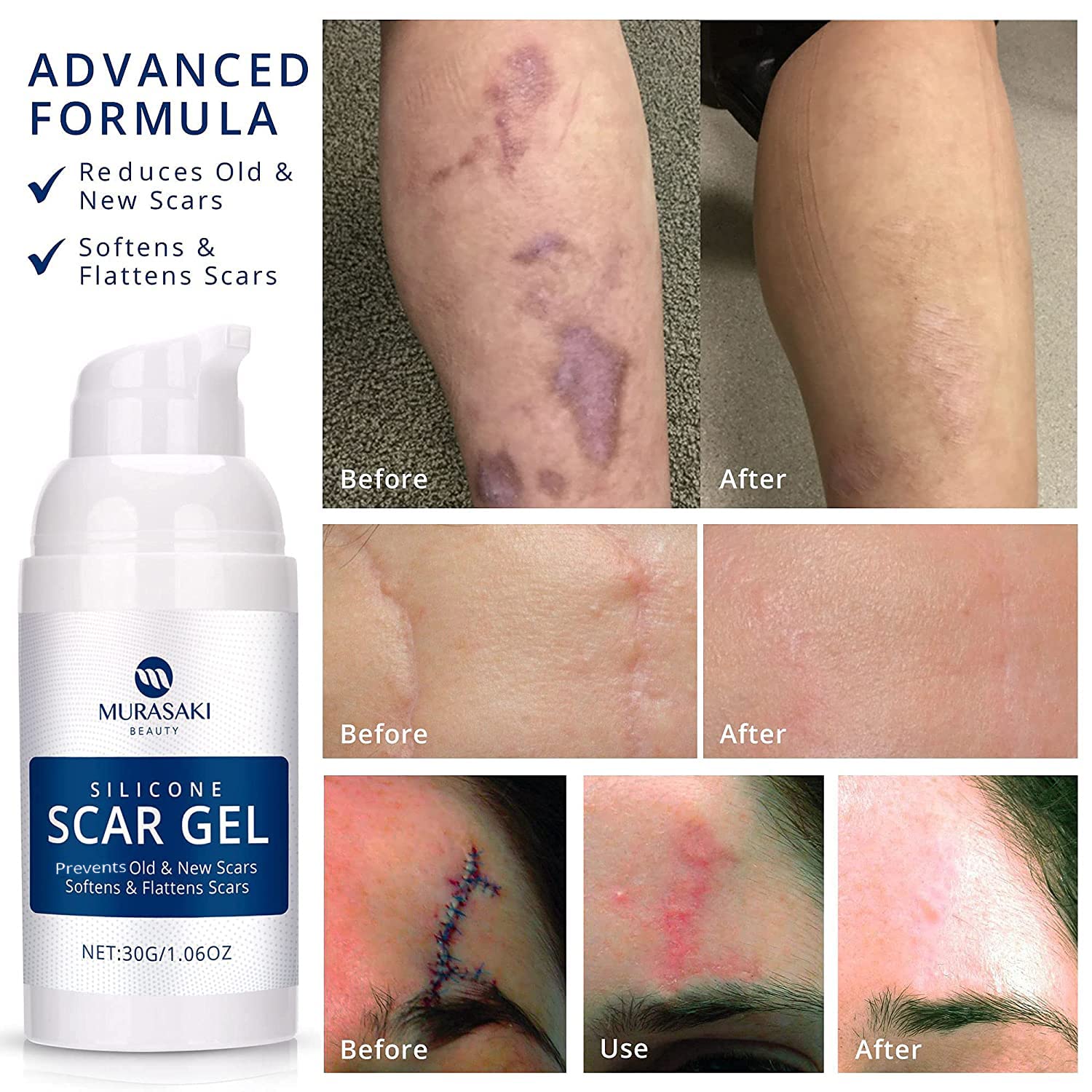100% Silicone Scar Gel Scar Cream - Advanced Scar Gel for Surgical Scars, C-Section, Stretch Marks, Acne, Injury, Burns, Keloids