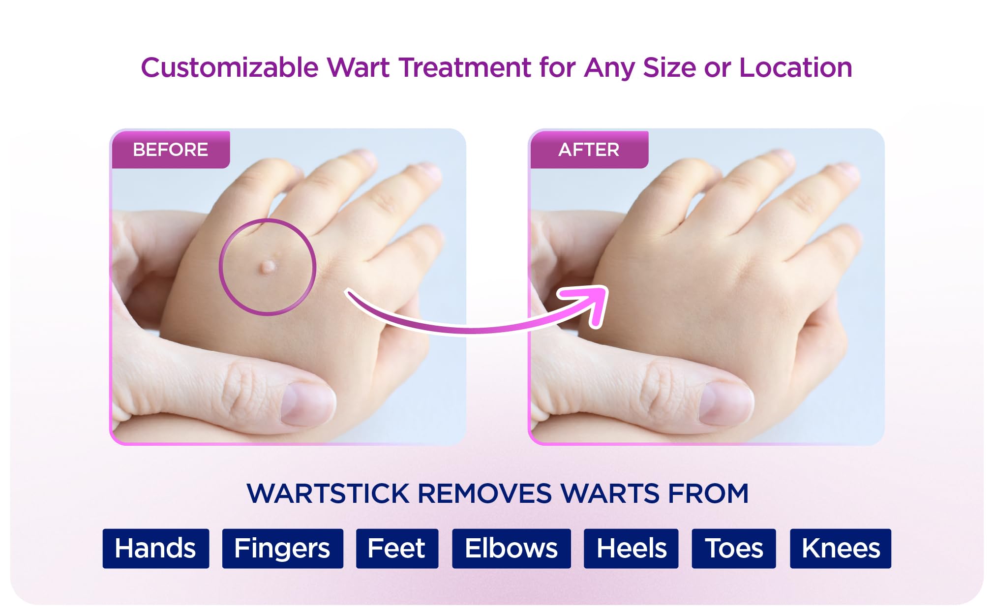 WartStick Maximum Strength Salicylic Acid Solid-Stick Common and Plantar Wart Remover 2 Pack, 0.4 Oz