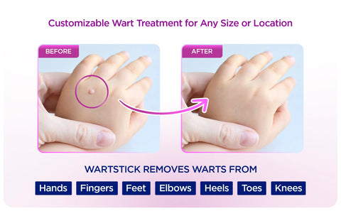WartStick Maximum Strength Salicylic Acid Solid-Stick Common and Plantar Wart Remover 2 Pack, 0.4 Oz