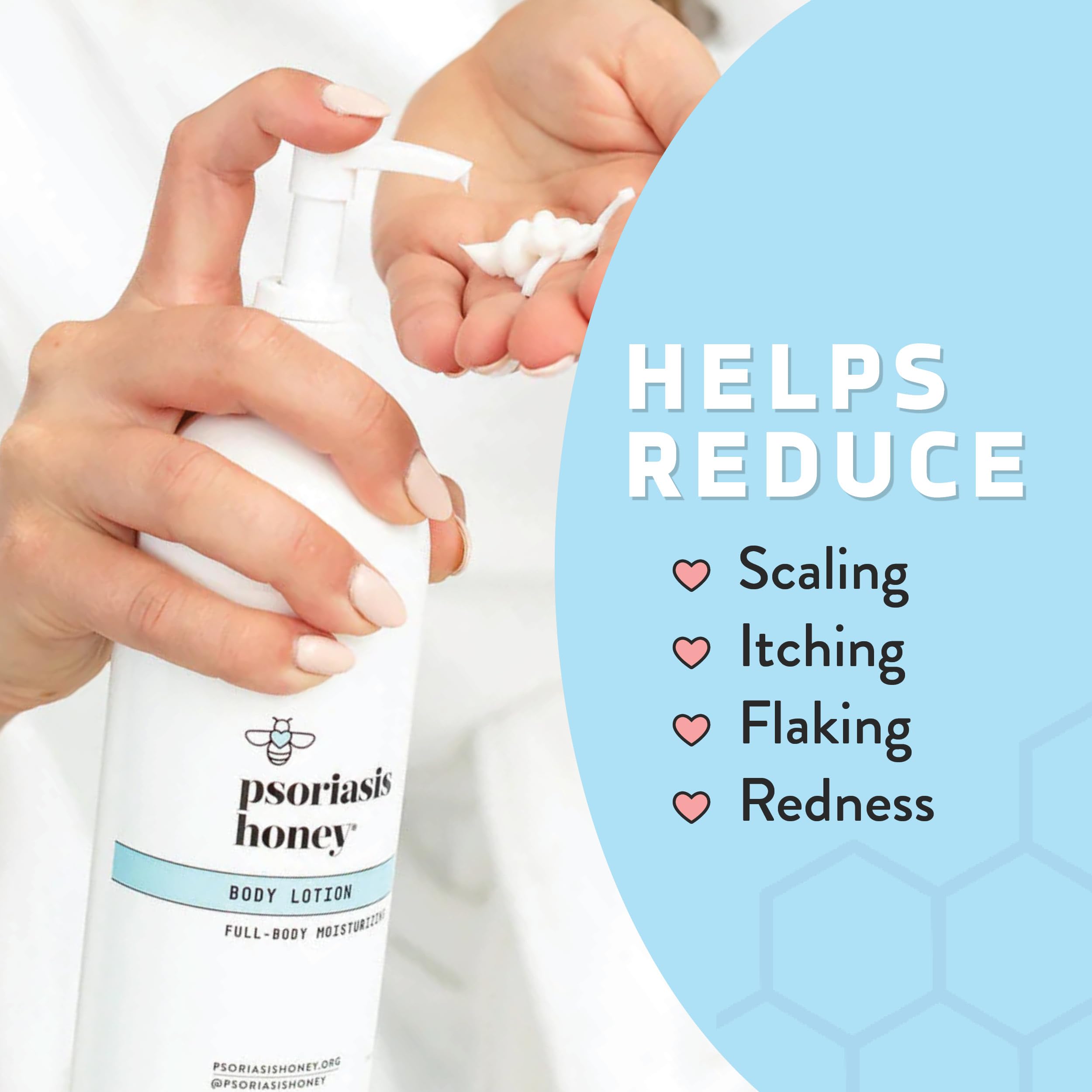 PSORIASIS HONEY Daily Moisturizing Body Lotion - Eczema & Seborrheic Dermatitis Cream for Itchy & Flaking - Moisturizing Psorias