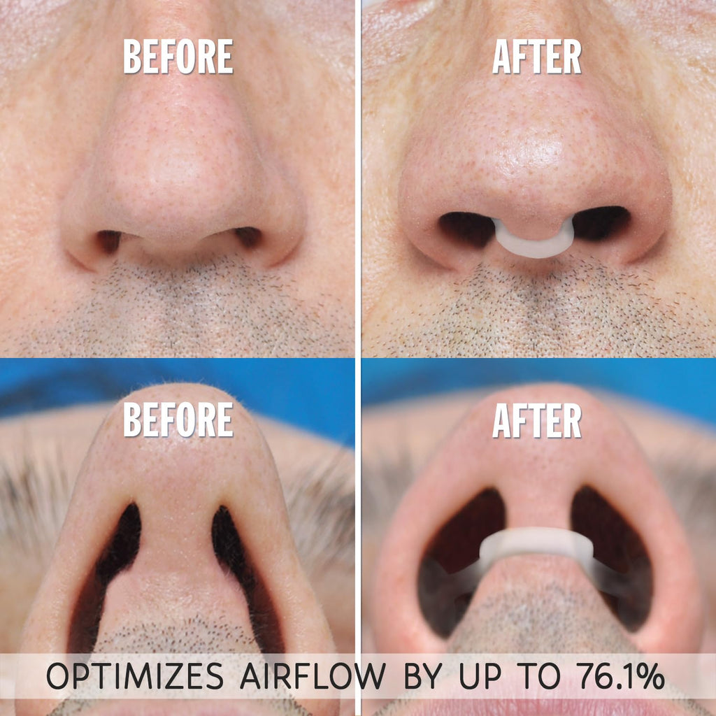 AIRMAX Nasal Dilator for Better Sleep - Natural, Comfortable, Anti Snoring Device, Snoring Solution for Maximum Airflow and Easi