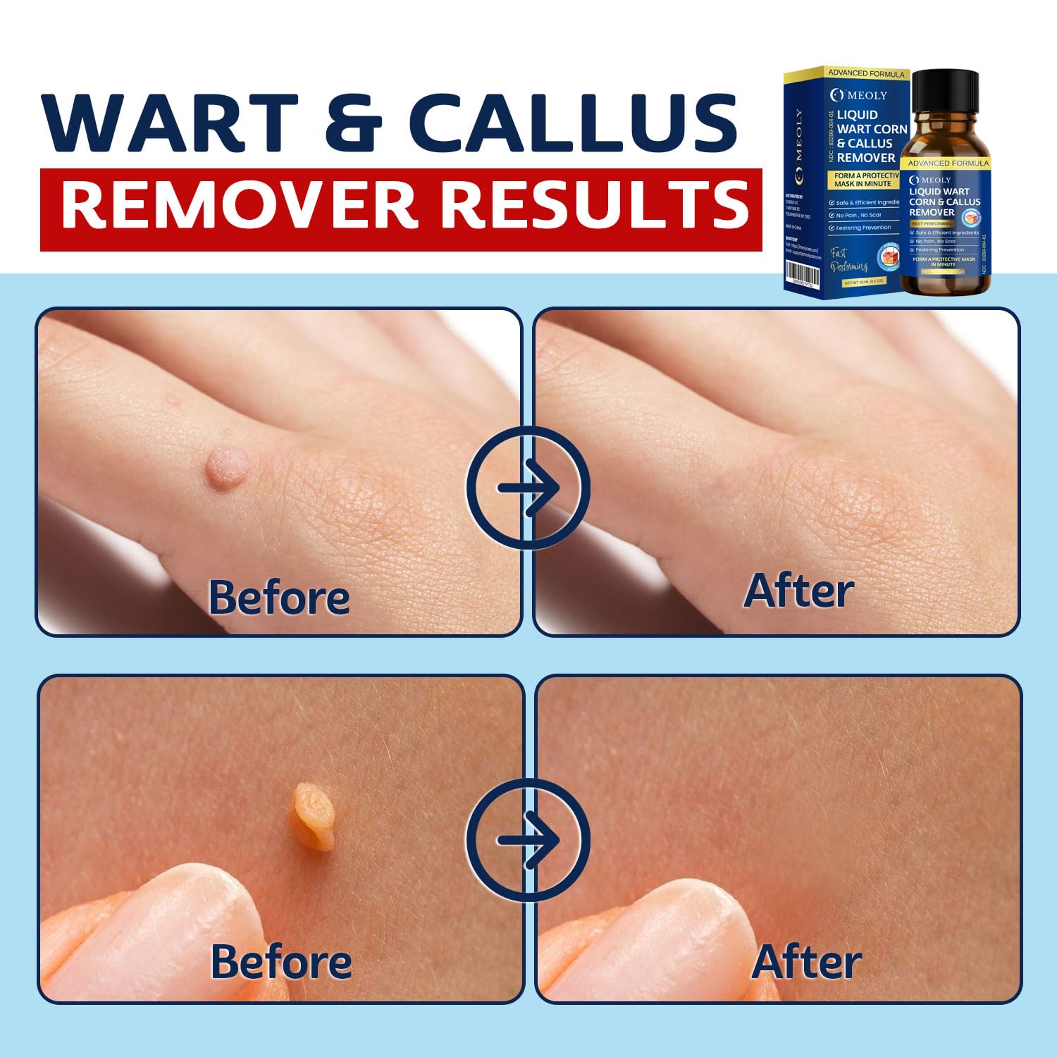 MEOLY Fast-Acting Wart Remover Freeze Off with Salicylic Acid for Plantar Warts & Corns, 30 ML, Clean, Suitable for Men and Women