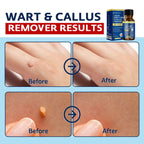 MEOLY Fast-Acting Wart Remover Freeze Off with Salicylic Acid for Plantar Warts & Corns, 30 ML, Clean, Suitable for Men and Women