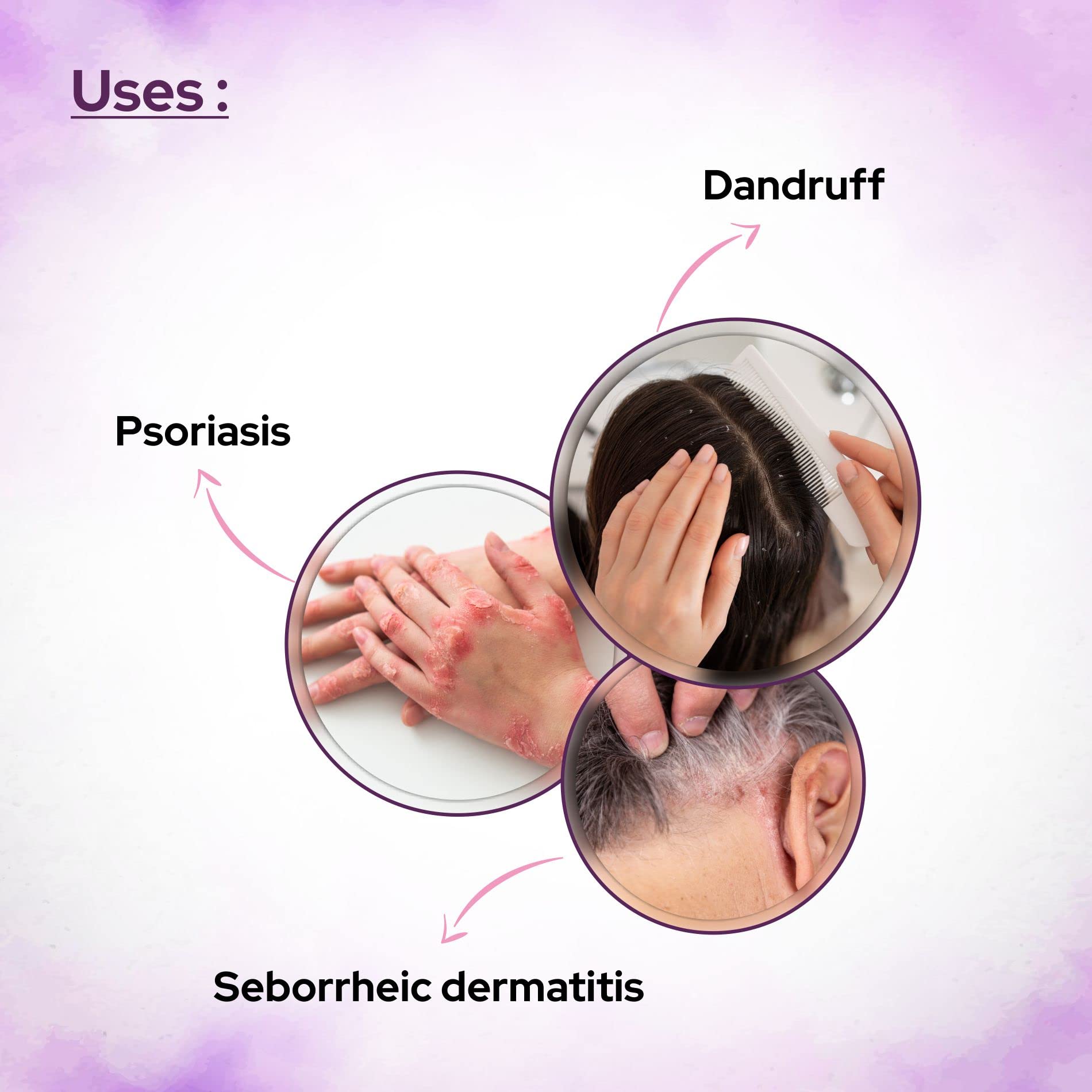 Plaintar Coal Tar 5% Leave on Lotion Reduces Scaling Dryness & Itching Coal Tar Lotion for Dandruff Psoriasis & Seborrheic Derma