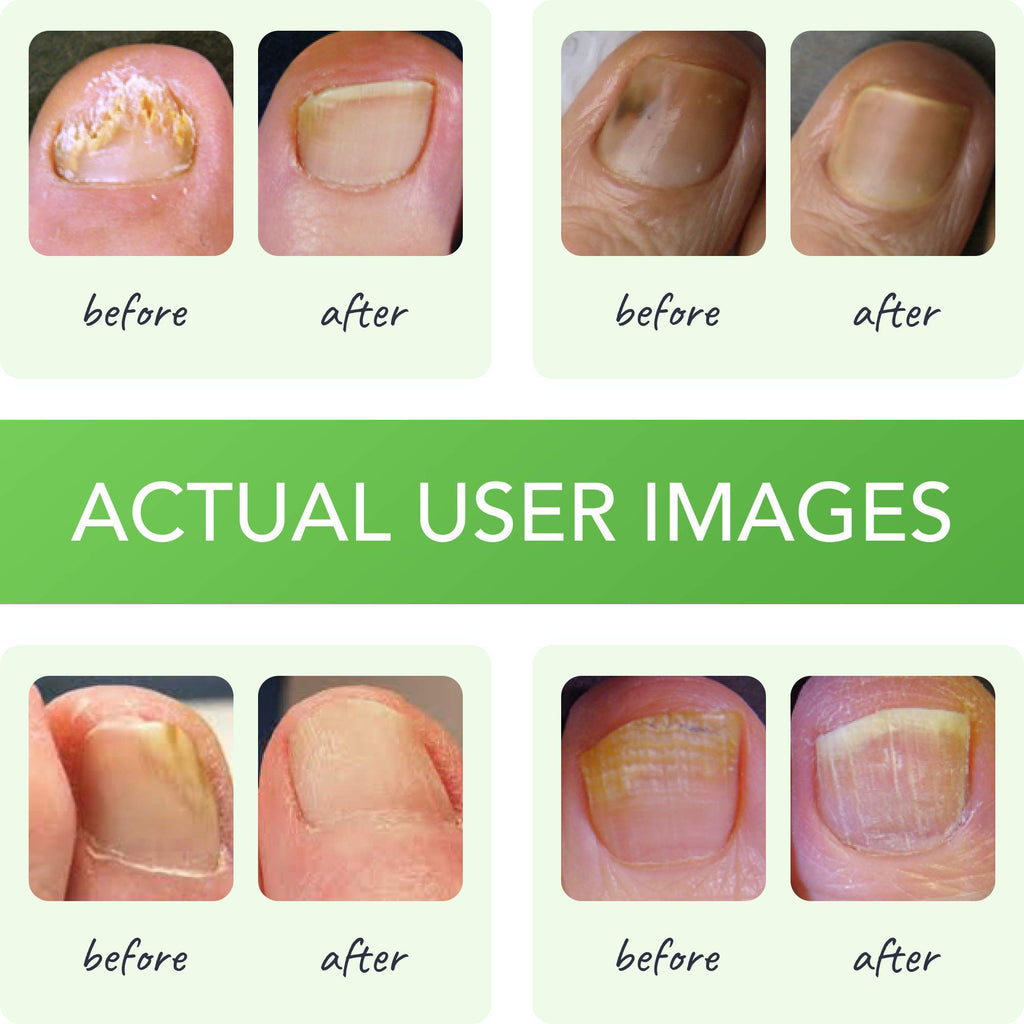FUNGINIX Toenail Fungus Treatment - Maximum Strength - Nail Fungus Treatment for Fungal Nails - Antifungal Liquid Solution - Mad