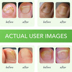 FUNGINIX Toenail Fungus Treatment - Maximum Strength - Nail Fungus Treatment for Fungal Nails - Antifungal Liquid Solution - Mad