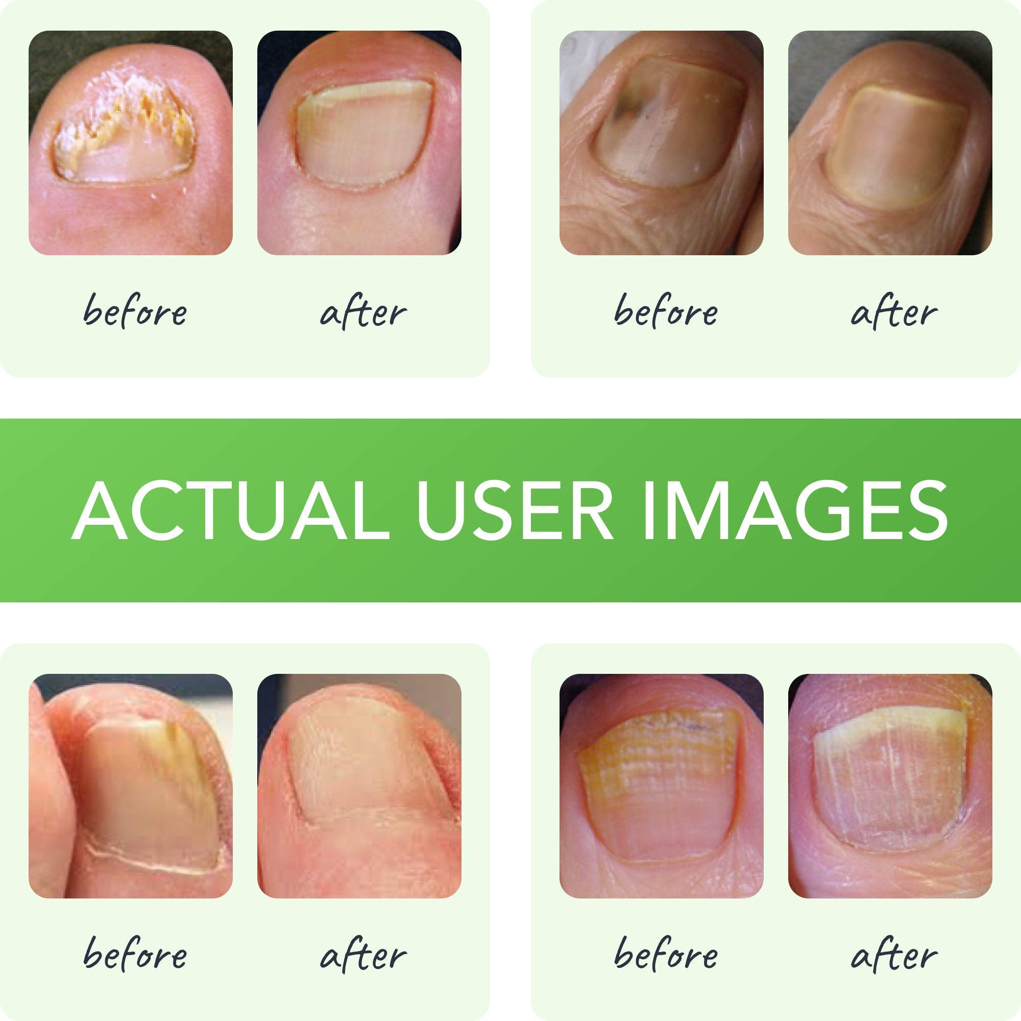 FUNGINIX Toenail Fungus Treatment - Maximum Strength - Nail Fungus Treatment for Fungal Nails - Antifungal Liquid Solution - Mad