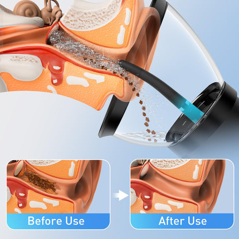 HeaDot Electric Ear Wax Removal, Retractable Water Ear Wax Cleaner, Effective Ear Cleaning Kit, IPX6 Ear Irrigation Flushing Sys