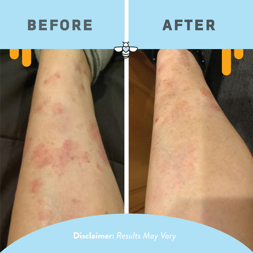 PSORIASIS HONEY Daily Moisturizing Body Lotion - Eczema & Seborrheic Dermatitis Cream for Itchy & Flaking - Moisturizing Psorias