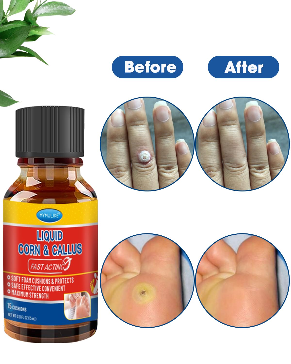 MYMULIKE Liquid Corn Remover, Corn Removers for Toes, Fast Acting Liquid for Corn, Safe Removes Corns Fast Extra Strength for Ki