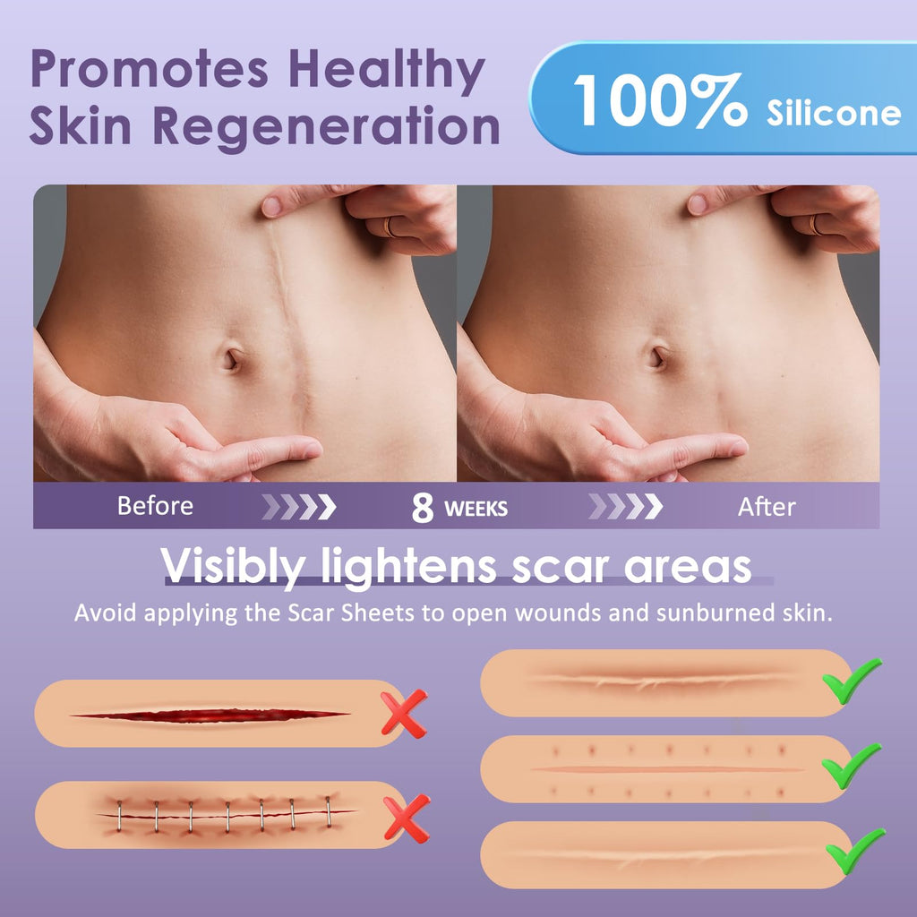 Skiennix Silicone Scar Tape for Surgical Scars - 1.6 x 120 300CM Roll - Reusable - Ultra Thin & Soft Scar Sheets for C-Sections,