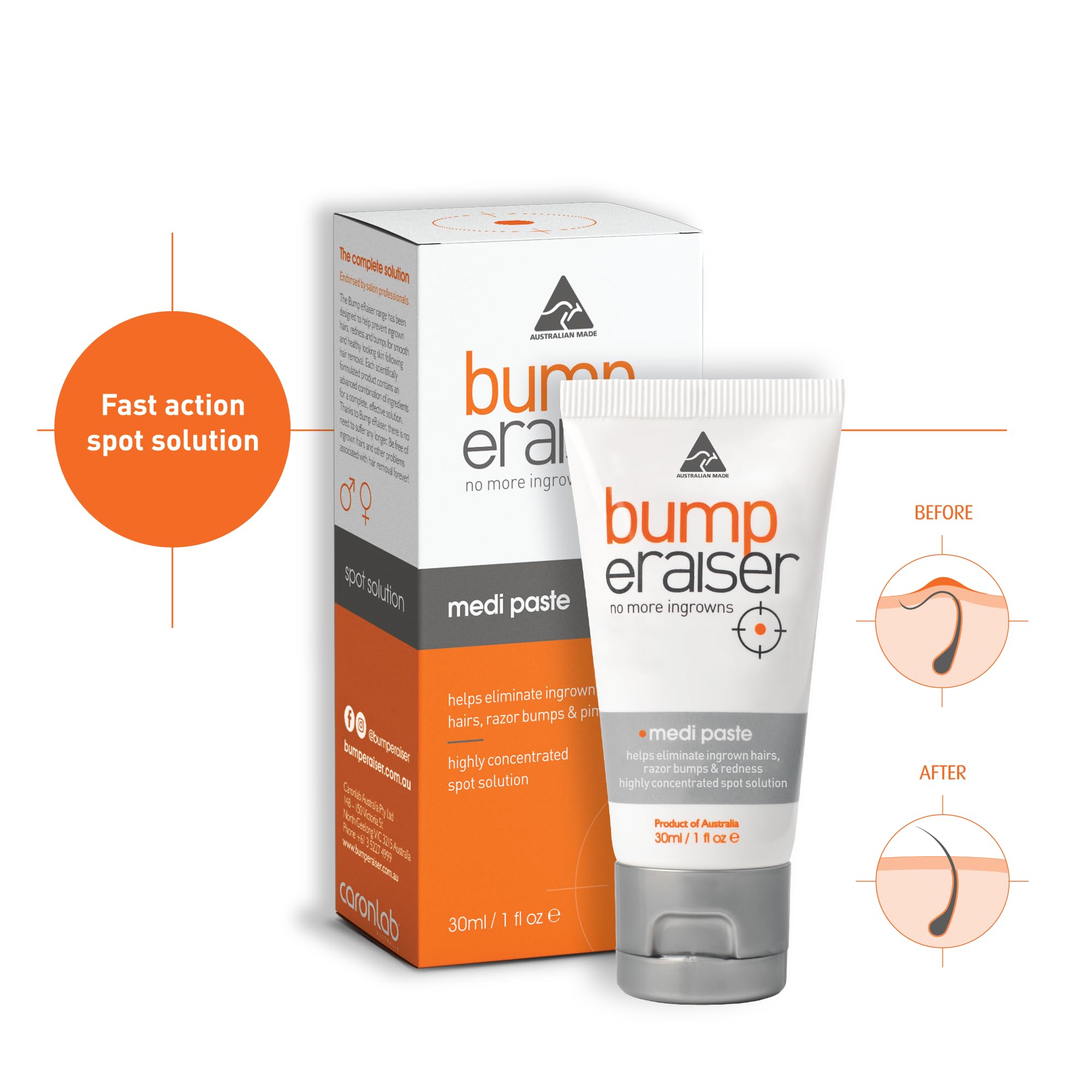 Bump Eraiser Medi Paste 1.0 fl oz for Shaving Rash, Ingrown Hair Treatment, Razor Bumps and Razor Burns