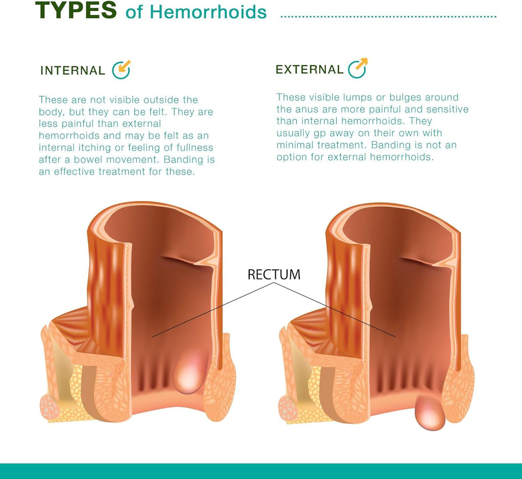 Reejoys Hemorrhoid Cream: Advanced Herbal Hemorrhoids Treatment Cream for Itching and Burning, Shrink & Soothe Hemorrhoids - 1.8