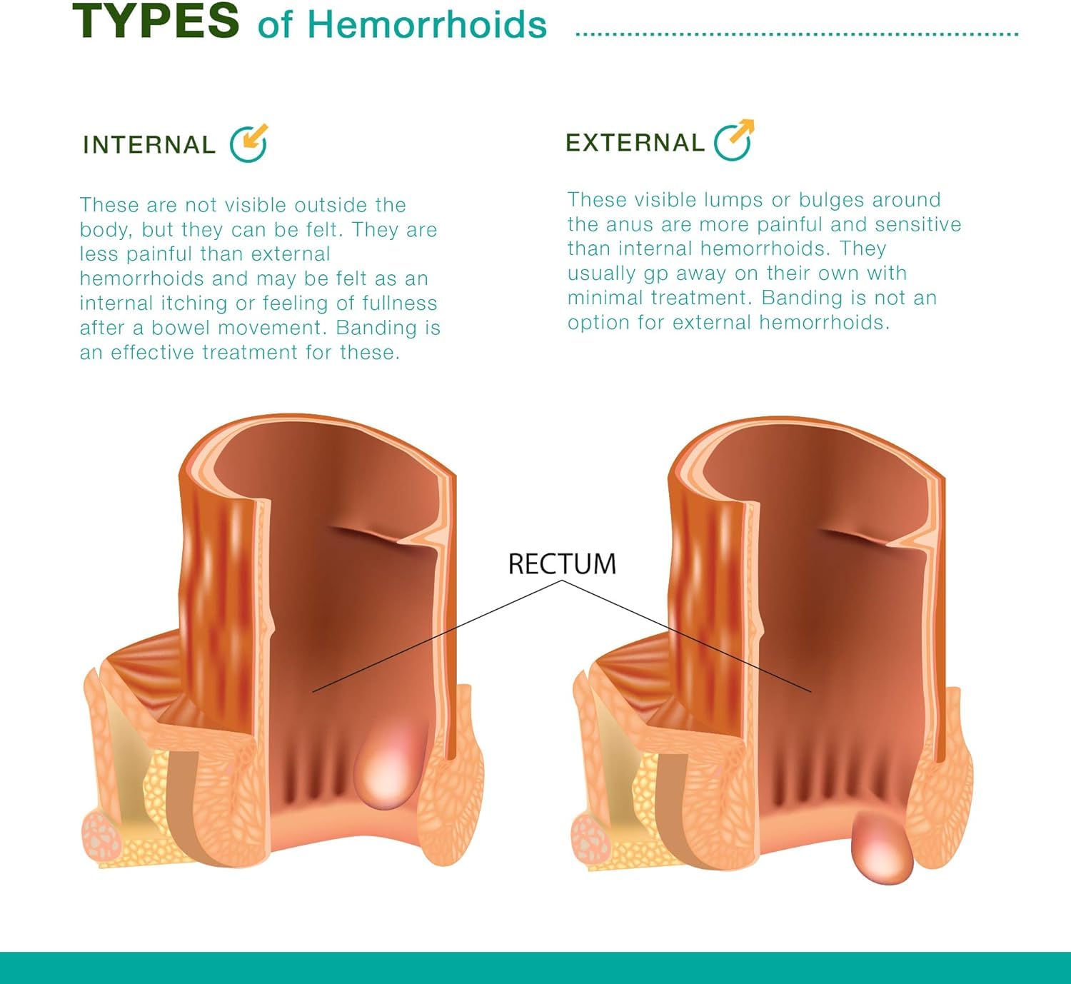 Reejoys Hemorrhoid Cream: Advanced Herbal Hemorrhoids Treatment Cream for Itching and Burning, Shrink & Soothe Hemorrhoids - 1.8