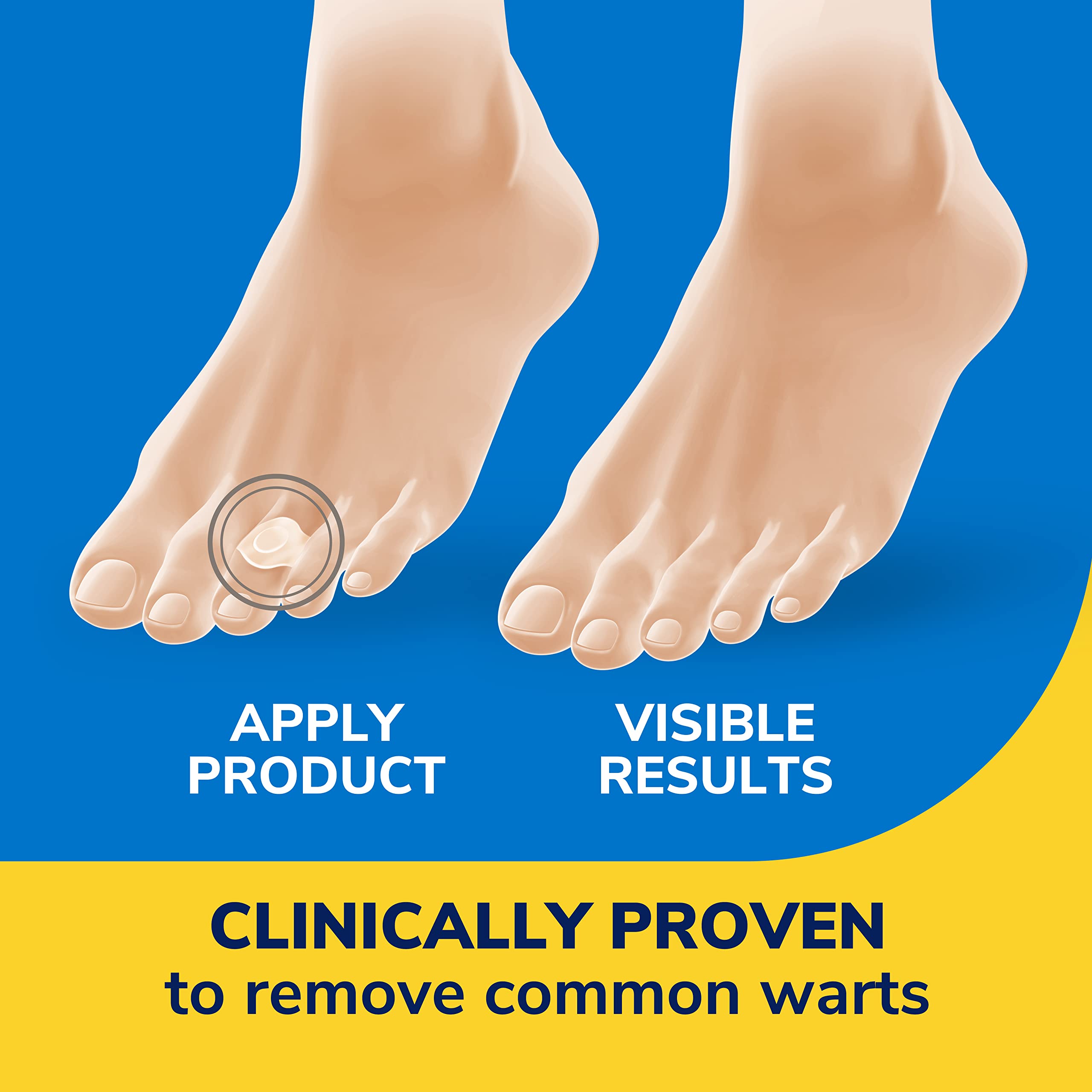 Dr. Scholl's Clear Away WART Remover HYDROGEL Bandage // 12 Discs/9 Cushions, Clinically Proven, Immediate & All-Day Cushioning