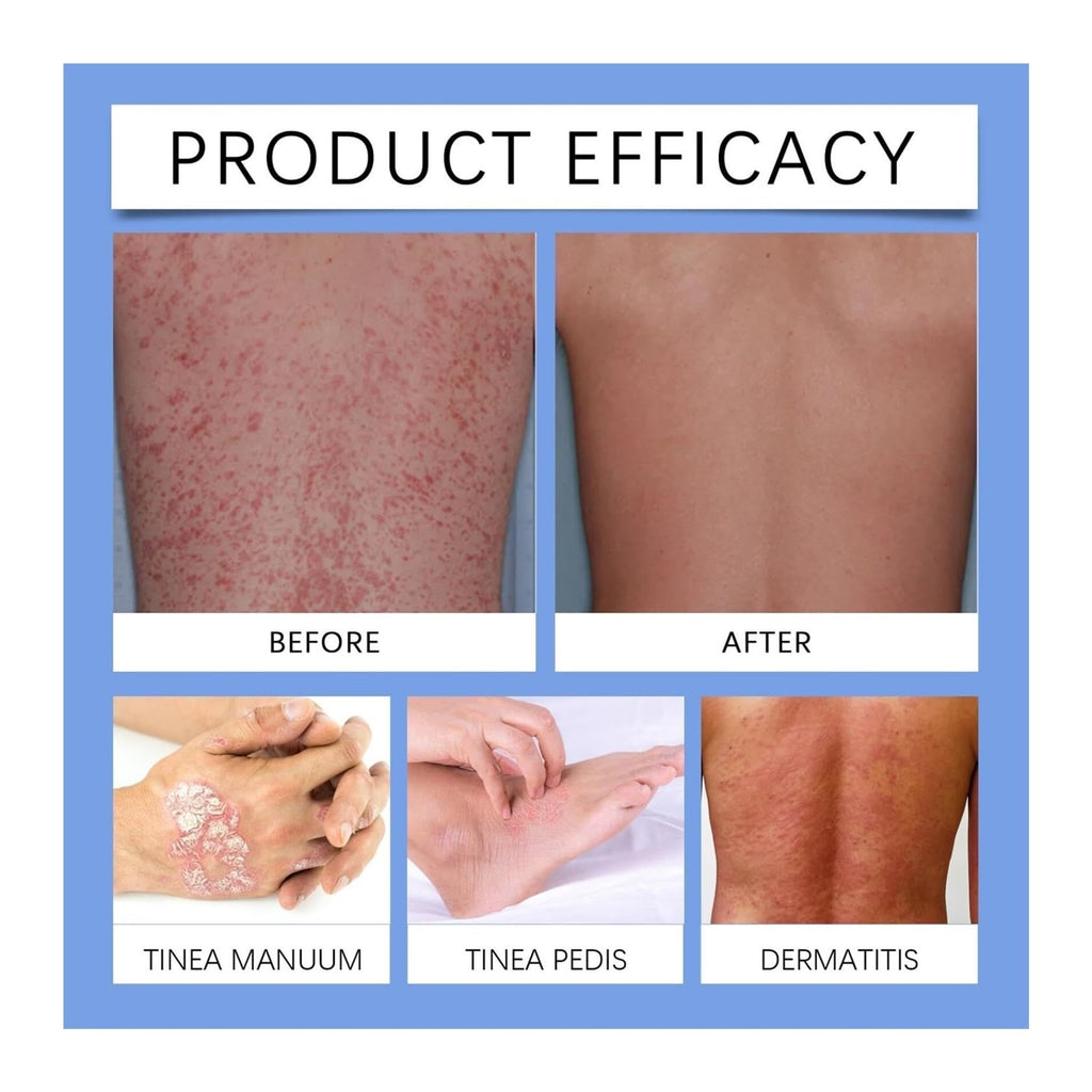 Lmuwecno Bee Venom Psoriasis