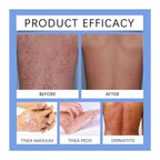 Lmuwecno Bee Venom Psoriasis