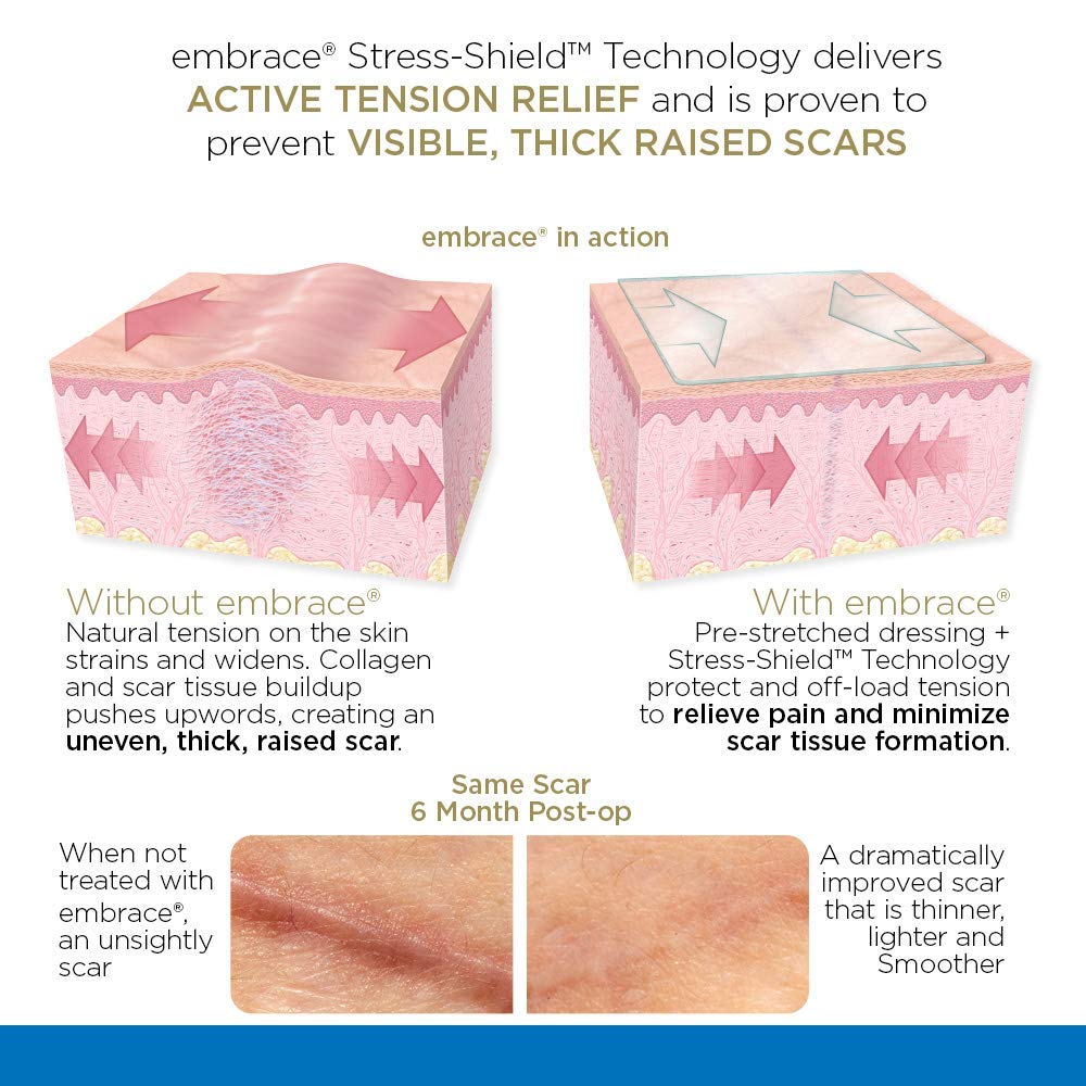Embrace Active Scar Defense for New Scars, FDA-Cleared Silicone Scar Sheets, 4.7 Inch, Large, 30 Day Supply