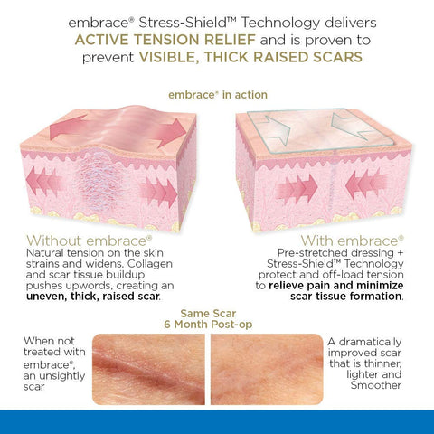 Embrace Active Scar Defense for New Scars, FDA-Cleared Silicone Scar Sheets, 4.7 Inch, Large, 30 Day Supply