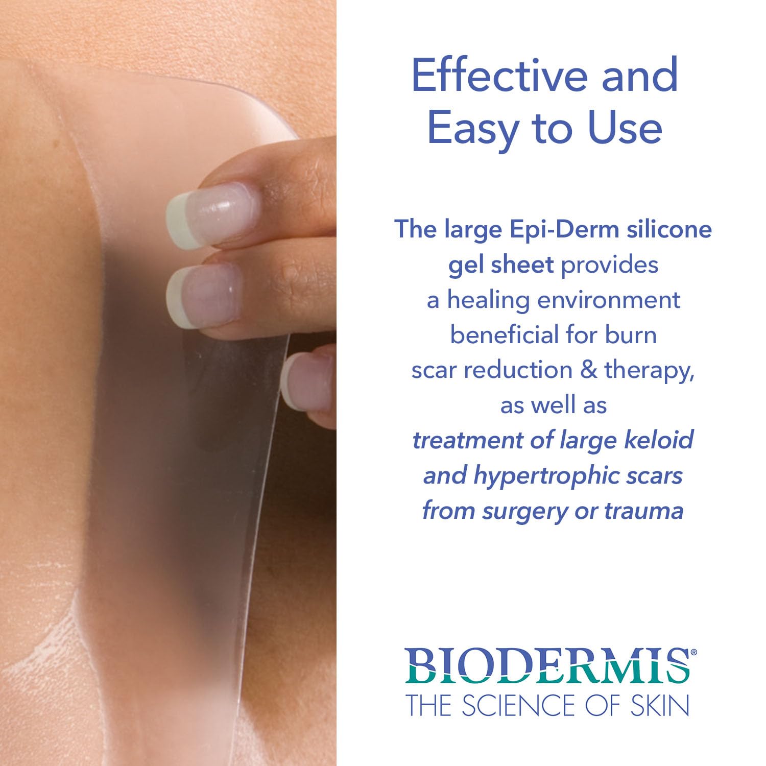 Epi-Derm Large Sheets, Premium Grade Silicone Scar Sheets for C-Section, Tummy Tuck, Hysterectomy & Cardiac Surgery Scars, Easy