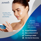 Seborrheic Dermatitis Psoriasis Cream: Antifungal Treatment - Traditional Herbal Infused - Relief for Flaking Irritated Scalp Sk