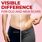 Medical Grade Silicone Scar Sheets - 6pk (7   x1.6   ) - Visible Difference on C-Section Scars - Reusable Silicone Sheets for Sc