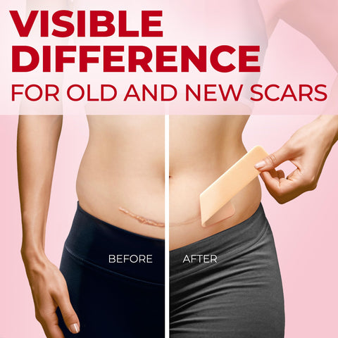 Medical Grade Silicone Scar Sheets - 6pk (7   x1.6   ) - Visible Difference on C-Section Scars - Reusable Silicone Sheets for Sc