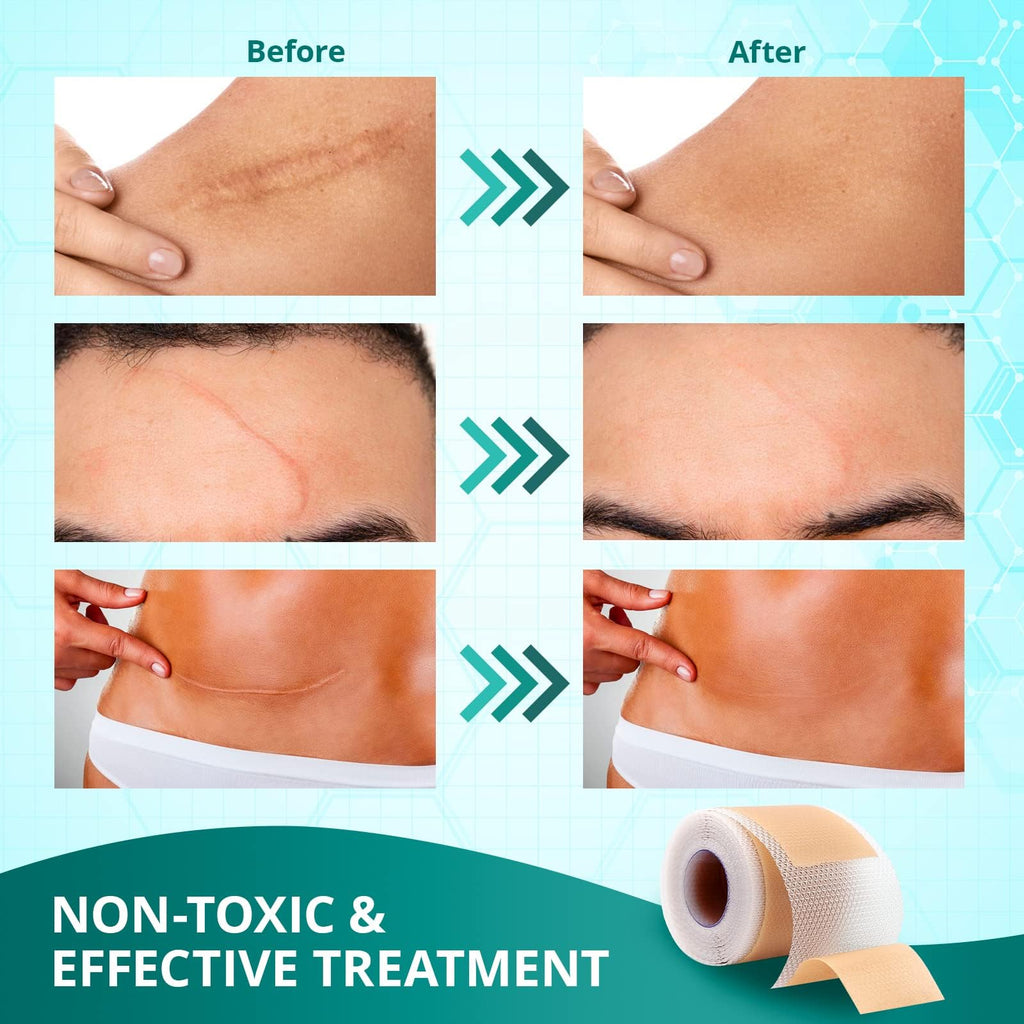 Silicone Scar Sheets,Silicone Scar Tape(1.6''x 60'' Roll-1.5M), Reusable and Effective Scar Removal Sheets, Silicone Scar Remova
