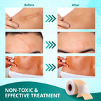 Silicone Scar Sheets,Silicone Scar Tape(1.6''x 60'' Roll-1.5M), Reusable and Effective Scar Removal Sheets, Silicone Scar Remova