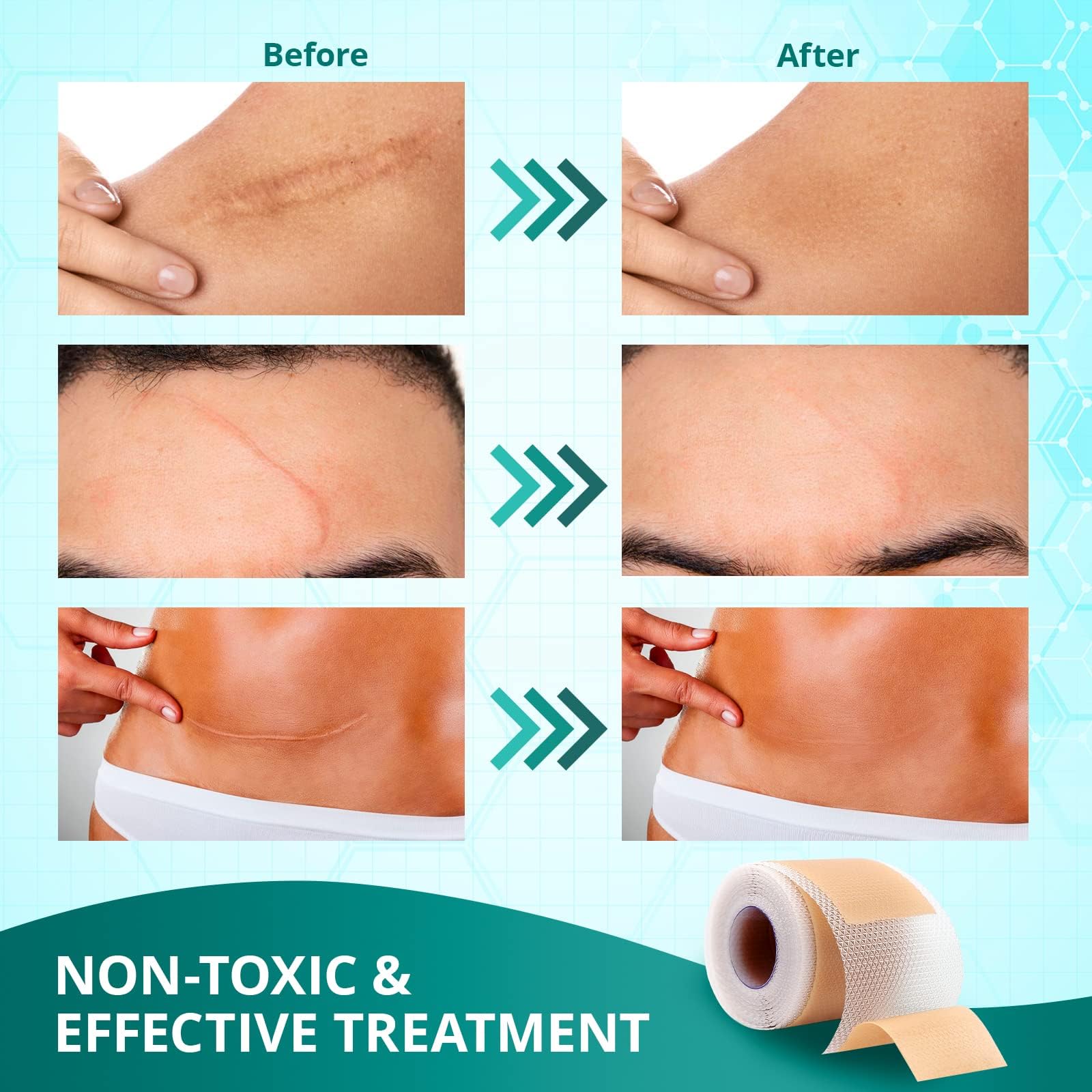 Silicone Scar Sheets,Silicone Scar Tape(1.6''x 60'' Roll-1.5M), Reusable and Effective Scar Removal Sheets, Silicone Scar Remova