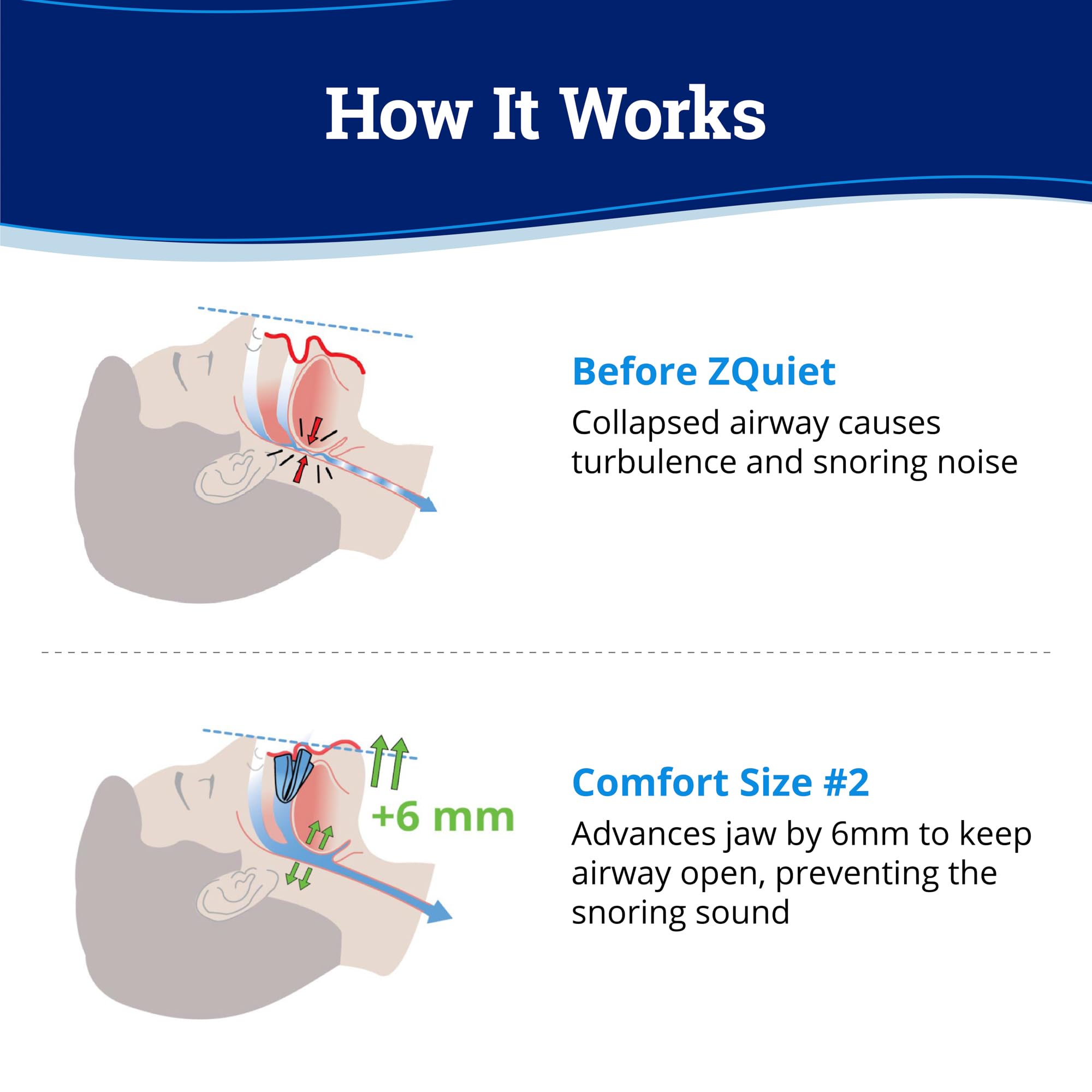 ZQuiet Anti-Snoring Mouthpiece Solution - Comfort Size #2 (Single Device) + Cleaner (1.5oz Bottle) - Made in USA Snoring Solutio