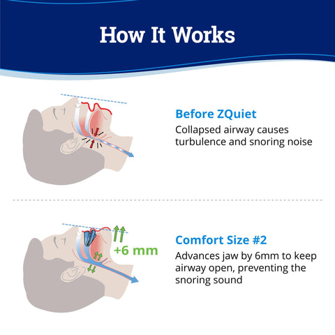 ZQuiet Anti-Snoring Mouthpiece Solution - Comfort Size #2 (Single Device) + Cleaner (1.5oz Bottle) - Made in USA Snoring Solutio