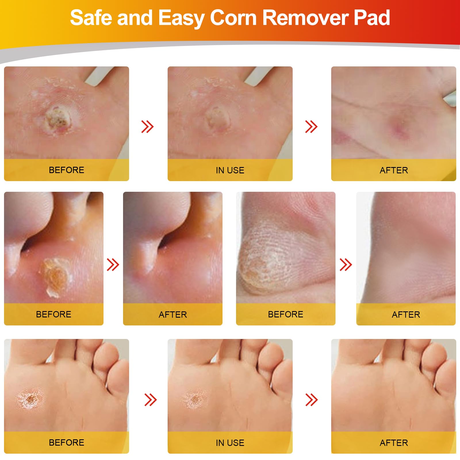 MYMULIKE Corn Removers for Feet, 24 Pack, 2 Size Corn Removers for Toe, Corn Remover Feet, 12 Large Size and 12 Small Size Foot