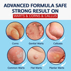 MEOLY Fast-Acting Wart Remover Freeze Off with Salicylic Acid for Plantar Warts & Corns, 30 ML, Clean, Suitable for Men and Women