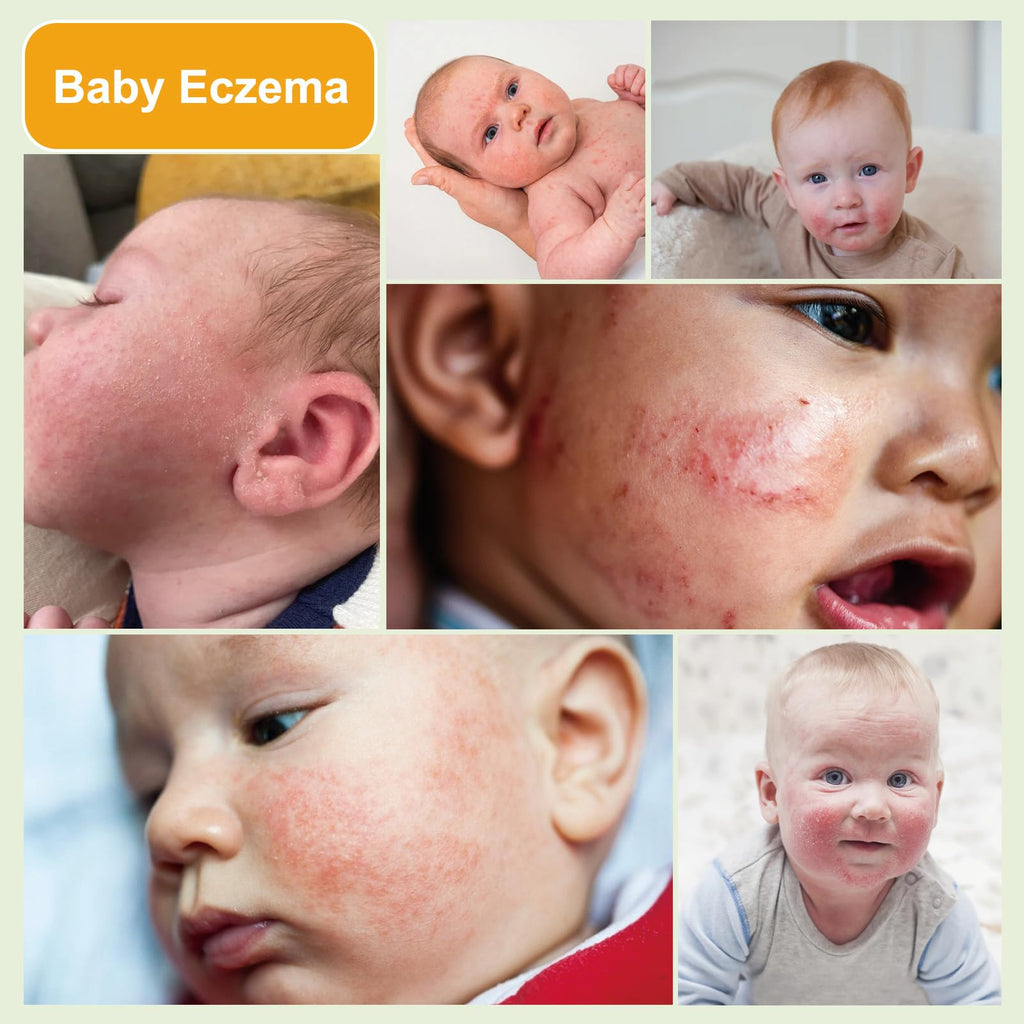 Baby Eczema Cream - Kids Eczema Therapy & Relief Body Cream, Nourishing Skin Protectant Soothes & Relieves Dry, Hypoallergenic,