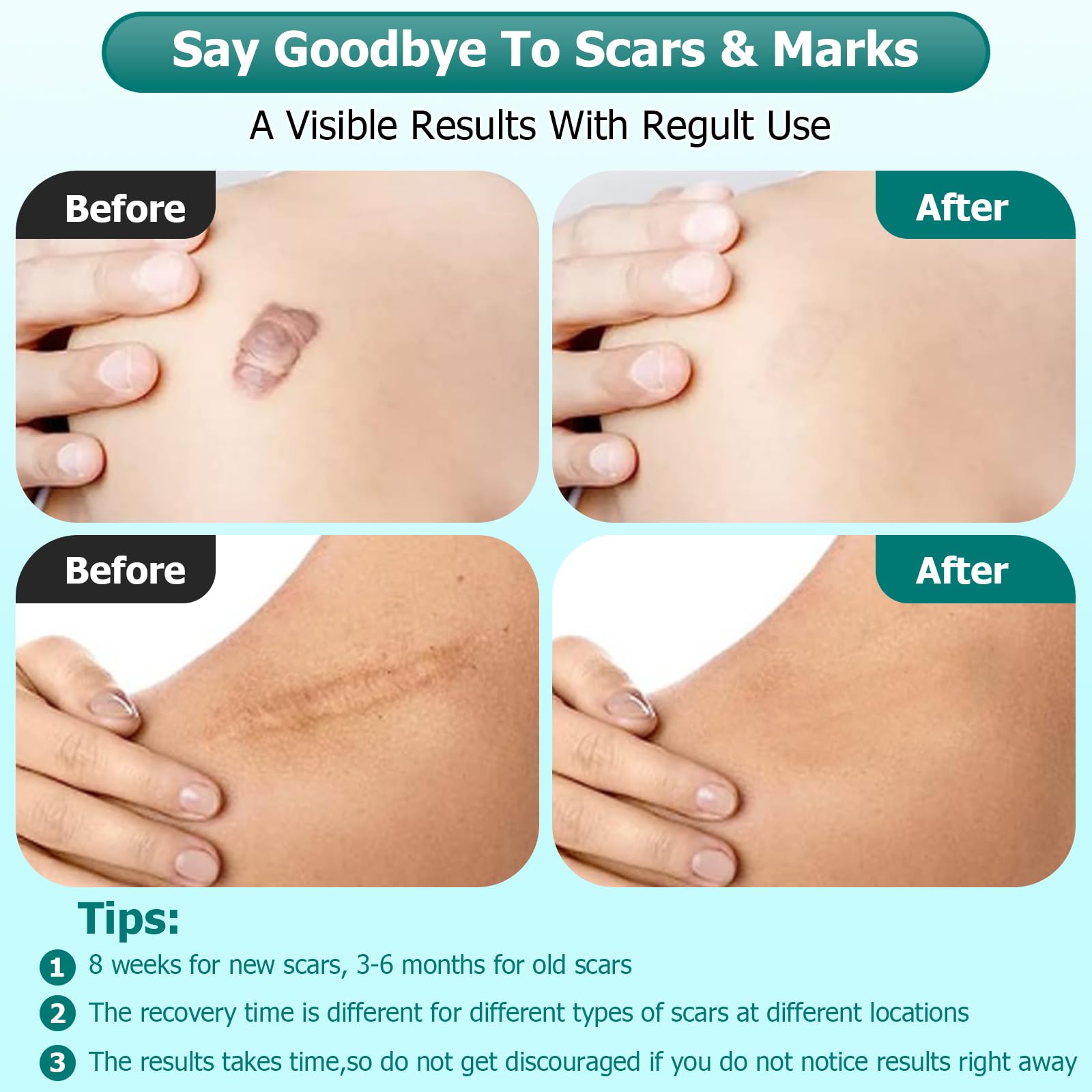 Gowgaw Scar Gel, Scar Cream, Advance Scar Gel for Surgical Scars,Face,Body,Leg, Burns, Acene,C-Section, Stretch Marks, Keloids,S