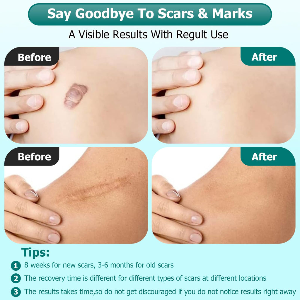 Gowgaw Scar Gel, Scar Cream, Advance Scar Gel for Surgical Scars,Face,Body,Leg, Burns, Acene,C-Section, Stretch Marks, Keloids,S